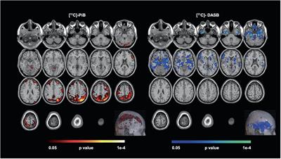 The utility of PET imaging in depression